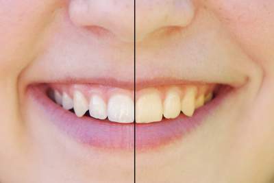 Best Way To Whiten My Teeth Naturally Best Way To Whiten My Teeth Naturally